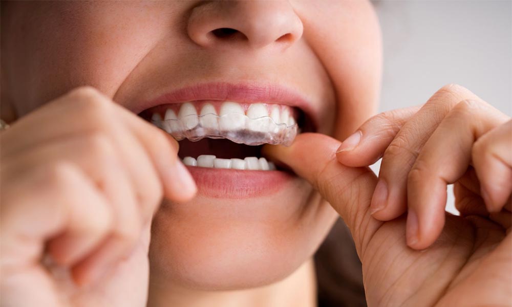 Invisalign Treatment in Portland, OR: What is it Like at Magic Smiles?