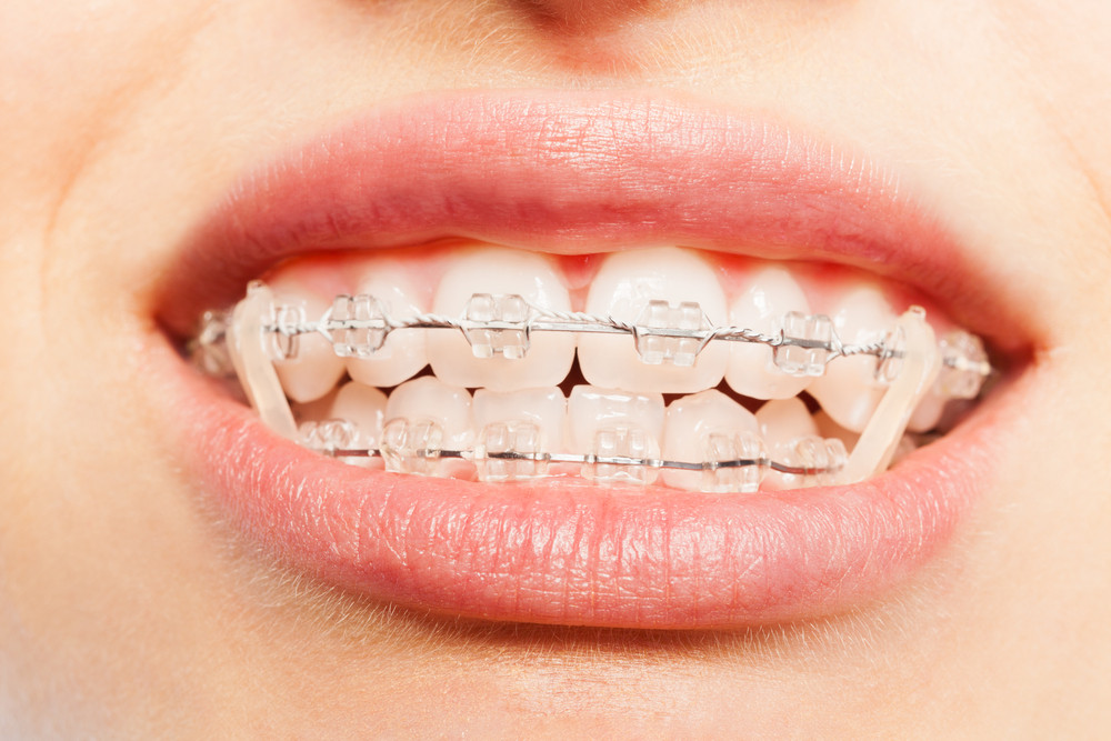 Elastics for Braces - Everything You Need to Know